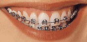 metal braces